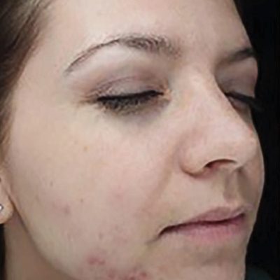 BBL acne - female, skin type 2 before