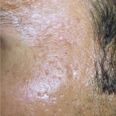 acne scar temples after