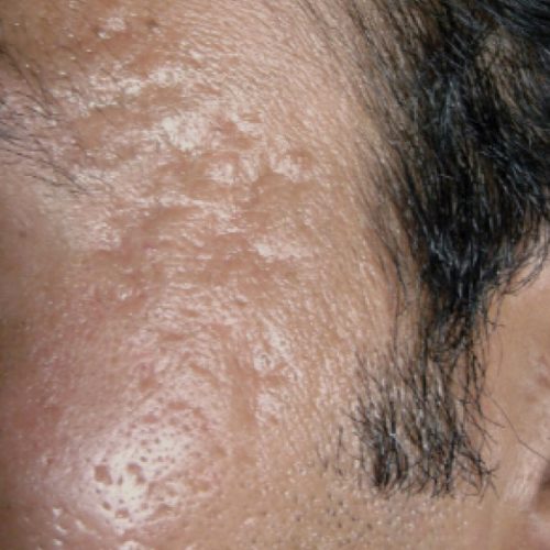 acne scar temples before