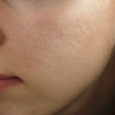 acne-scars-before-and-after-0507200002