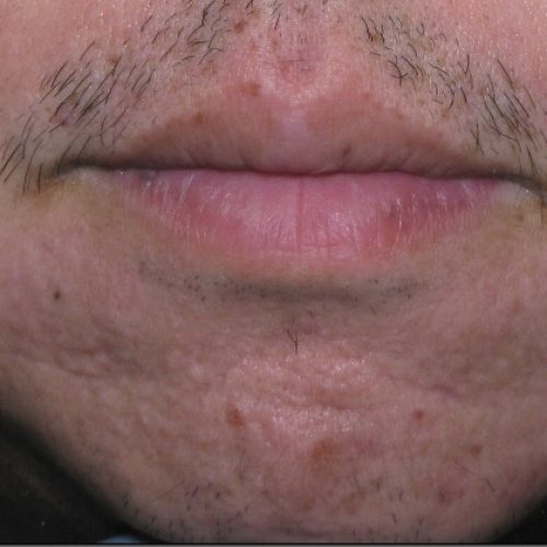 acne-scars-before-and-after-0507200003