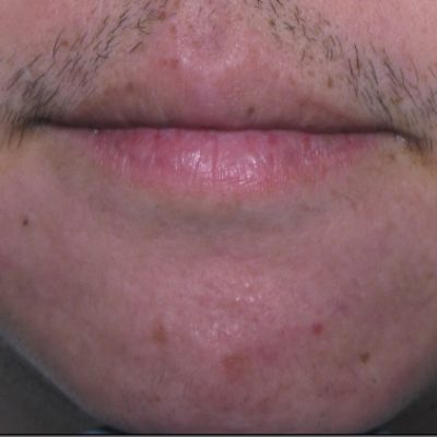acne-scars-before-and-after-0507200004