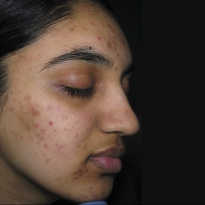 Acne Treatment Before and After | Kingsway Dermatology
