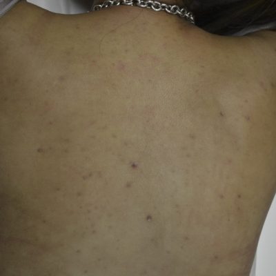 Back Acne Treatment Before and After | Kingsway Dermatology