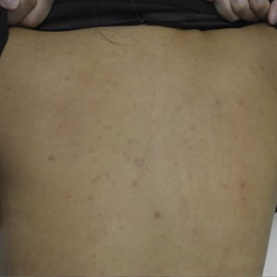 Back Acne Treatment Before and After | Kingsway Dermatology