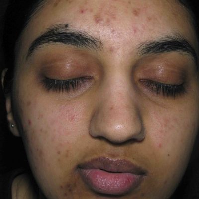 acne-scars-before-and-after-0518200006