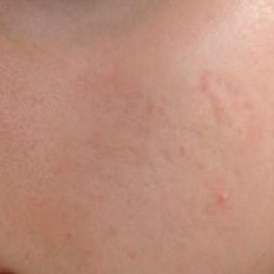 acne scars on cheeks after