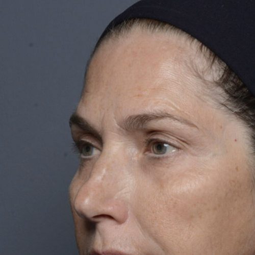 botox-before_case-one