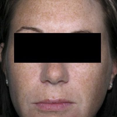 brown-spots-before-after-0507200010