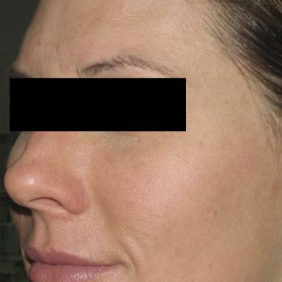brown-spots-before-after-0507200011