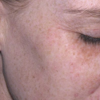 Brown Spots Before and After | Kingsway Dermatology