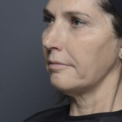 dermal-fillers-before-and-after0507200002