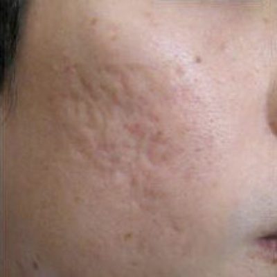microneedling-before-and-after-0507200001