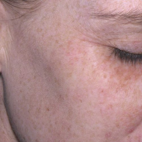 Pigmentation Before and After | Kingsway Dermatology