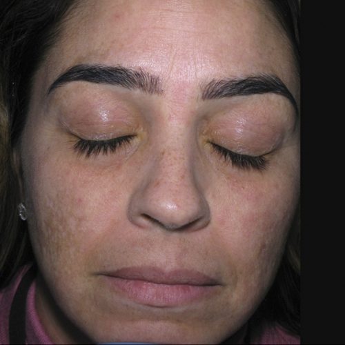 pigmentation-treatment-before-and-after-0507200001