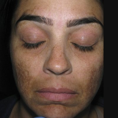 pigmentation-treatment-before-and-after-0507200002