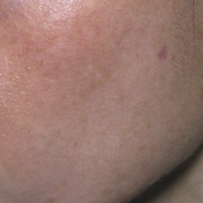 Pigmentation Treatment Before and After | Kingsway Dermatology