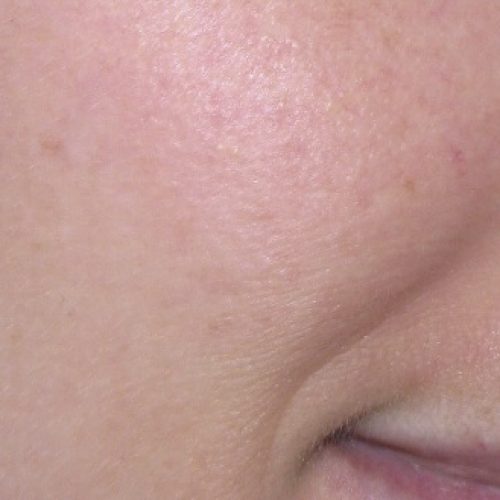 Pigmentation Treatment Before and After | Kingsway Dermatology