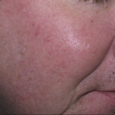 rosacea-treatment-before-and-after-0507200003