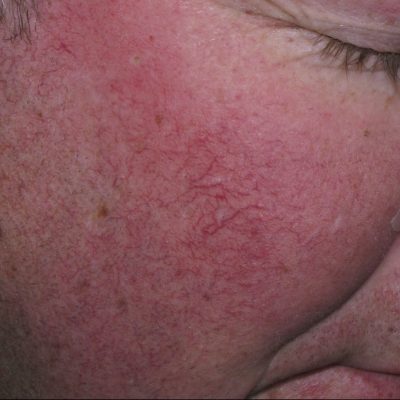 rosacea-treatment-before-and-after-0507200004