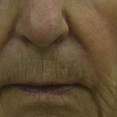 Wrinkle Treatment Before and After | Kingsway Dermatology