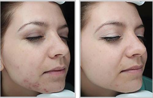 BBL acne - female, skin type 2