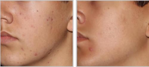 BBL acne - male, skin type 3