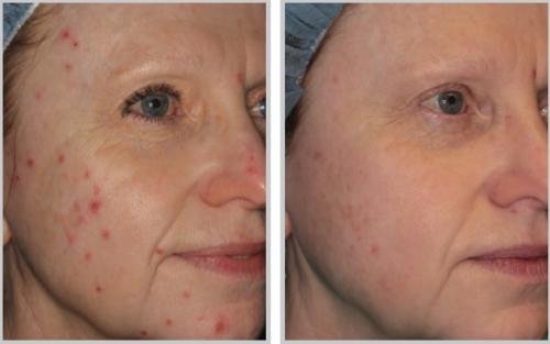 BBL acne - middle skin female, skin type 2