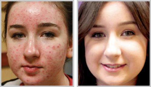 BBL acne - young female, skin type 2