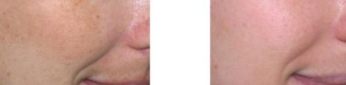 Melasma Right Cheek & Upper Lip, 1 Month Post Zo-Medical