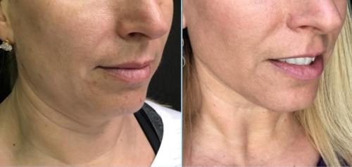 Ultherapy - Lower Face & Neck