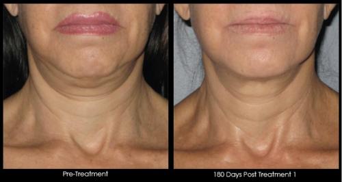 Ultherapy - female - neck - 50+