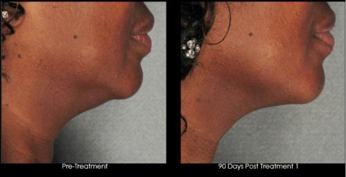 Ultherapy - female, skin type 6 - lower face and neck - 50+