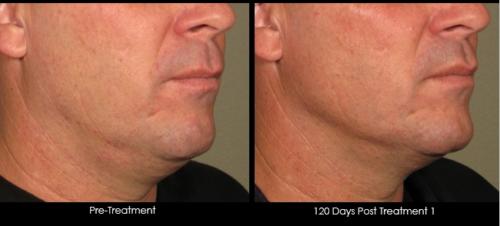 Ultherapy - male - lower face - 40-50