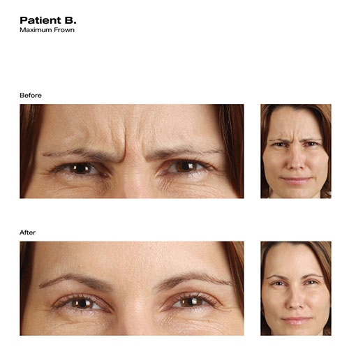 before-after_botox_patient-b