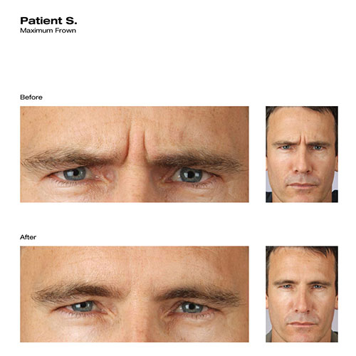 before-after_botox_patient-s