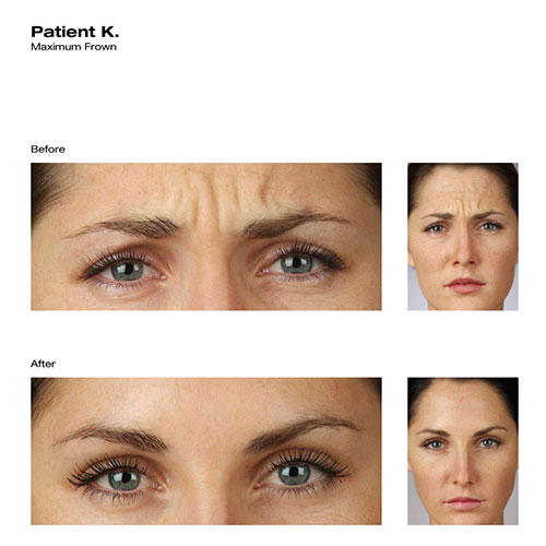 Before & After Skin Revitalization for Patient K